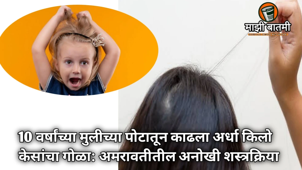 Amravati’s Rare Case: 10 वर्षांच्या मुलीच्या पोटातून काढला अर्धा किलो केसांचा गोळा: अमरावतीतील अनोखी शस्त्रक्रिया